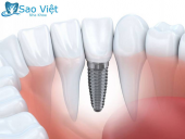 Thực Hiện Cấy Ghép Răng Implant Uy Tín Tại Nha Khoa