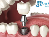 Implant Là Gì? Nha Khoa Implant Nào Uy Tín Tại TPHCM?