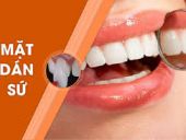 NHA KHOA PHÚ NHUẬN NÀO DÁN SỨ VENEER UY TÍN?