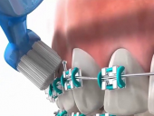 LỜI KHUYÊN TỪ NHA KHOA UY TÍN KHI CHĂM SÓC RĂNG NIỀNG