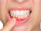 MÁCH BẠN CÁCH NGĂN CHẶN VIÊM NƯỚU RĂNG Ở TRẺ