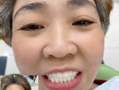 BỌC RĂNG SỨ VÀ LỜI KHUYÊN TỪ CÁC NHA KHOA UY TÍN